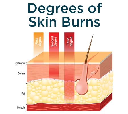 Chart of burns on skin